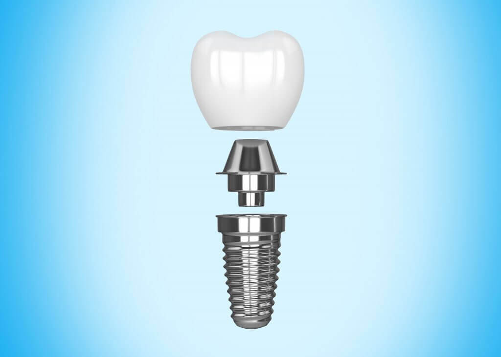 Dental Implants to improve your smile | VitalEurope