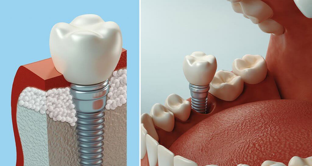 dental-bone-grafting-vitaleurope-dental-clinic-treatment