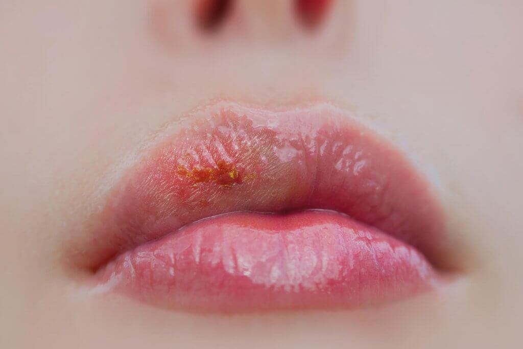 The Most Common Mouth Infections Part 2 Cold Sore VitalEurope